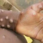 Nigeria Records 39 Mpox Cases in 2024, NCDC Intensifies Surveillance and Response