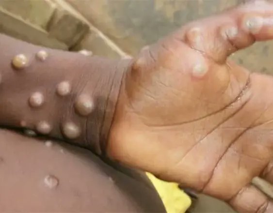 Nigeria Records 39 Mpox Cases in 2024, NCDC Intensifies Surveillance and Response